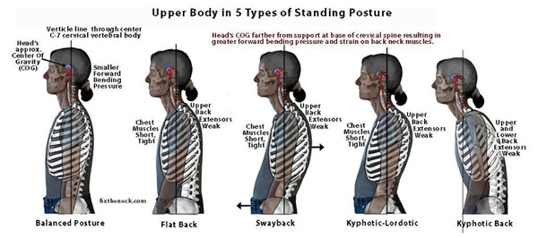 The 5 Types of Posture. Find Out Which One You Have!